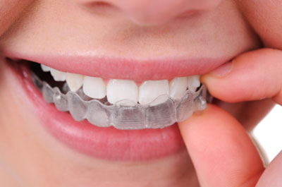 Invisalign Teeth Aligners 