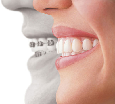 Invisalign Teeth Aligners 