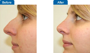 Nose Surgery: Before and After Pictures