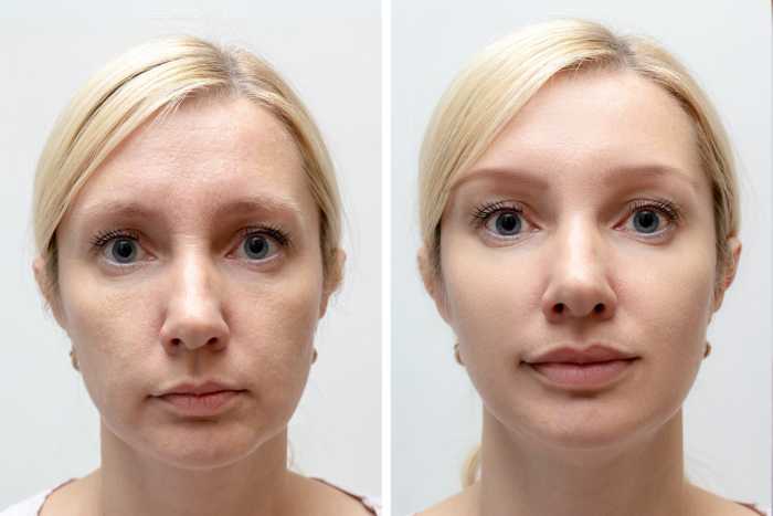 Woman face with wrinkles and age change before and after treatment - the result of rejuvenating cosmetological procedures of biorevitalization, face lifting and pigment spots removal.
