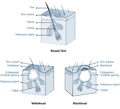 Noramal Skin, Whitehead & Blackhead