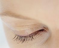 Eyelash Transplantation