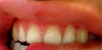 Stress Damages Teeth