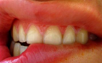 Stress Damages Teeth