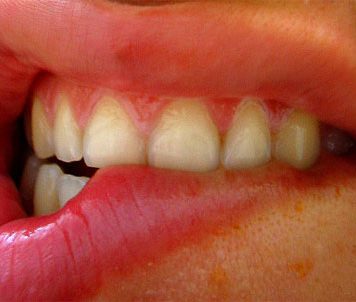 Stress Damages Teeth