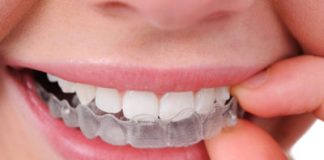 Invisalign Clear Teeth Aligners