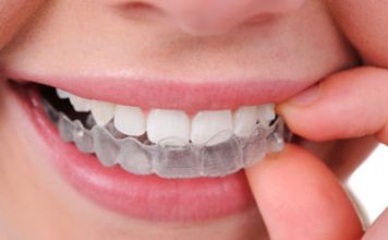 Invisalign Clear Teeth Aligners