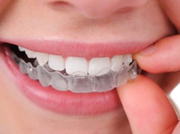 Invisalign Clear Teeth Aligners