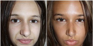 Nose Job to Rid a Teenage Girl of Bullying?