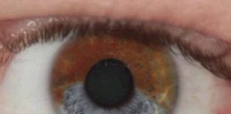 Laser Surgery to Change Eye Color
