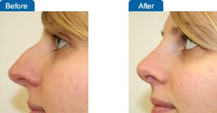 Thinking about Nose Surgery? Frequently Asked Questions