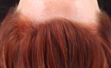 Hair Dye Causes Cancer