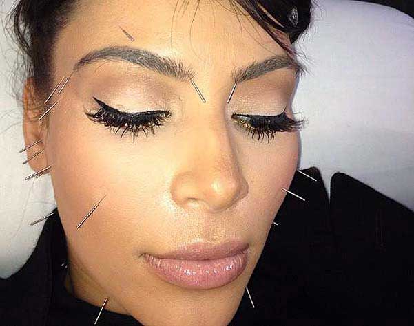 kim-kardashian-acupuncture