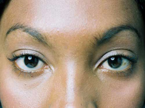 blepharoplasty