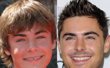 Celebrities' Smiles Before and After Correction