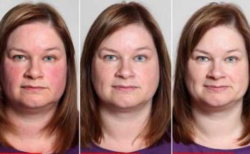 How Does the Face Change After Quitting Drinking?