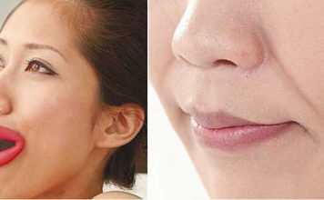 Anti-Wrinkle Gadget Mouthpiece