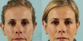 Cheek Augmentation Makes a Woman Look Younger