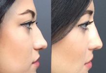 Things to Know Before Getting a Nose Job