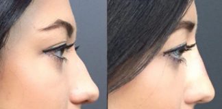 Things to Know Before Getting a Nose Job