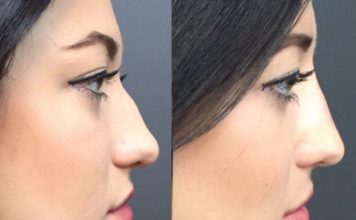 Things to Know Before Getting a Nose Job