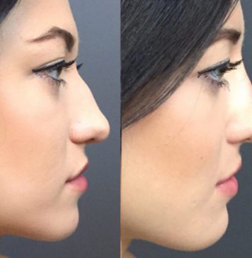 Things to Know Before Getting a Nose Job