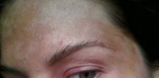 Microdermabrasion Made Woman’s Face Hyperpigmented