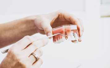 Are Dental Implants Always the Solution for Missing Teeth?