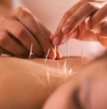5 Surprising Ways in which Acupuncture Improve Your Looks