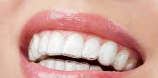 What to Expect After Invisalign Treatment?