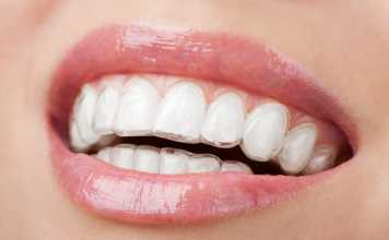 What to Expect After Invisalign Treatment?