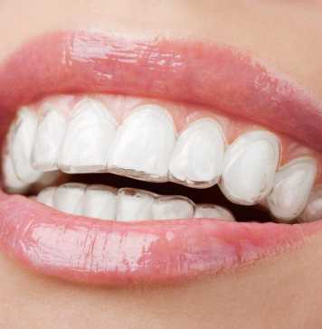 What to Expect After Invisalign Treatment?