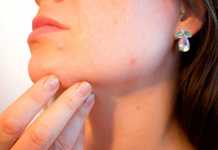 Tips for Acne Skin Care