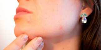 Tips for Acne Skin Care