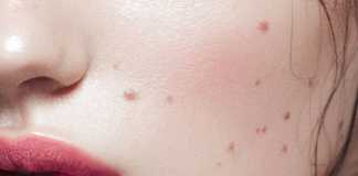 Mole or Tumor? How to Reduce Melanoma Risk?