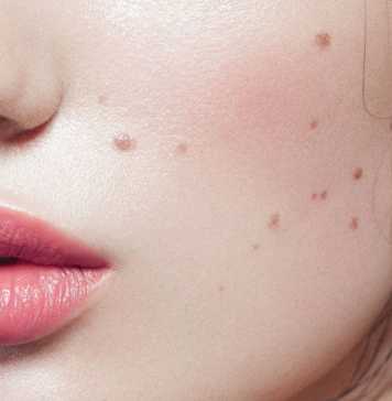 What You Need to Know about Mole Removal