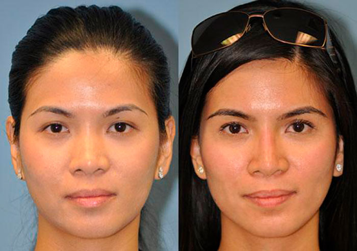 Non-surgical rhinoplasty.