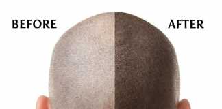 Scalp Micropigmentation Clinics – How to Choose the Best for You