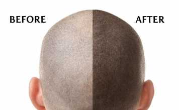 Scalp Micropigmentation Clinics – How to Choose the Best for You