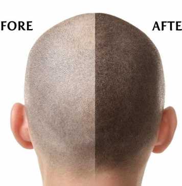Scalp Micropigmentation Clinics – How to Choose the Best for You