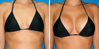 Most Popular Cosmetic Surgery among Skinny Women