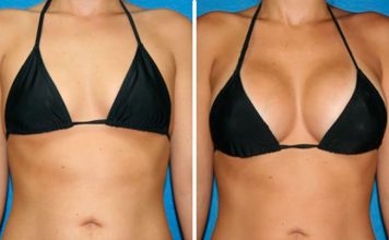 Most Popular Cosmetic Surgery among Skinny Women