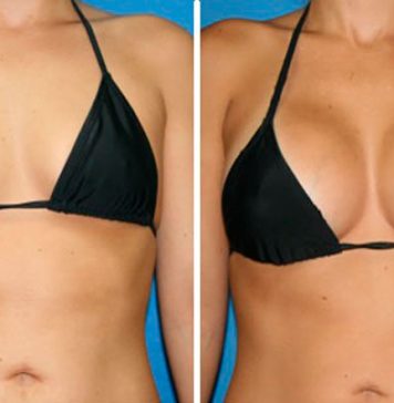 Most Popular Cosmetic Surgery among Skinny Women