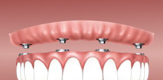 Tips For Taking Care Of Your Dental Implants