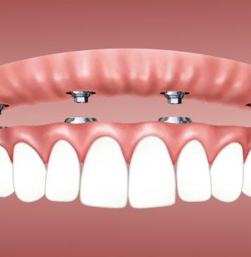 Tips For Taking Care Of Your Dental Implants