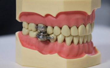Weirdest Weight Loss Method Ever: DentalSlim Diet Control