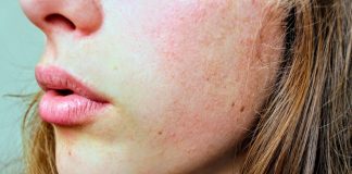 4 Probiotics for Acne Skin Treatment