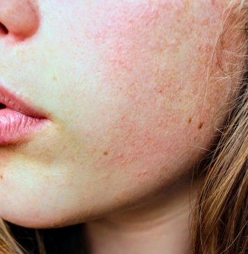 4 Probiotics for Acne Skin Treatment