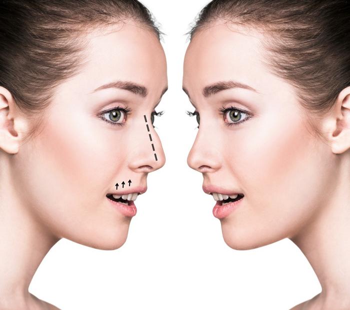 Nose Job Recovery Timeline And Stages Of Healing Geniusbeauty