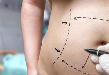 Liposuction vs Tummy Tuck: What’s the Difference?
